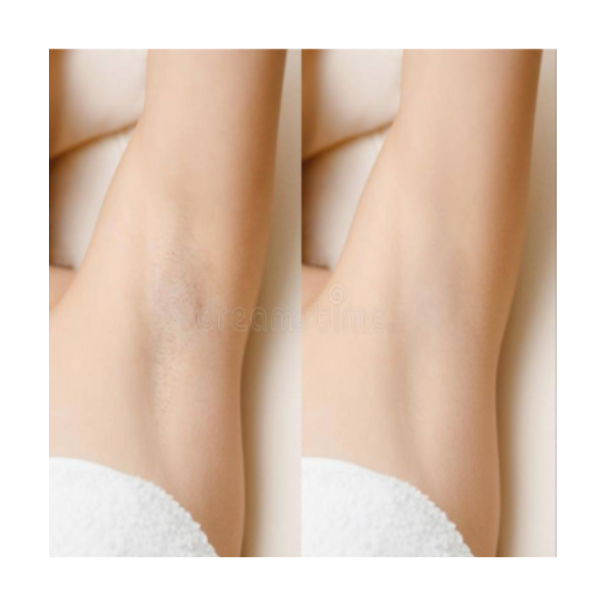 Body Permanent Hair Removal